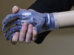 Литовцу установили бионный протез руки